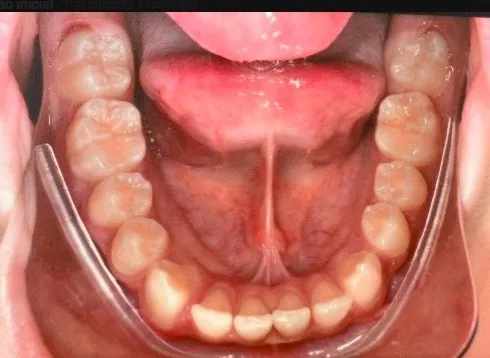 Antes - Invisalign