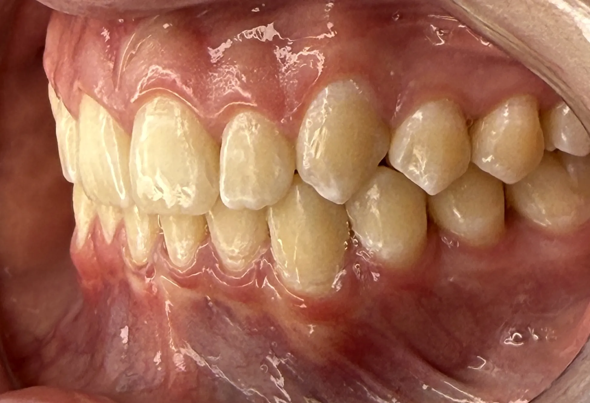 Depois - Invisalign