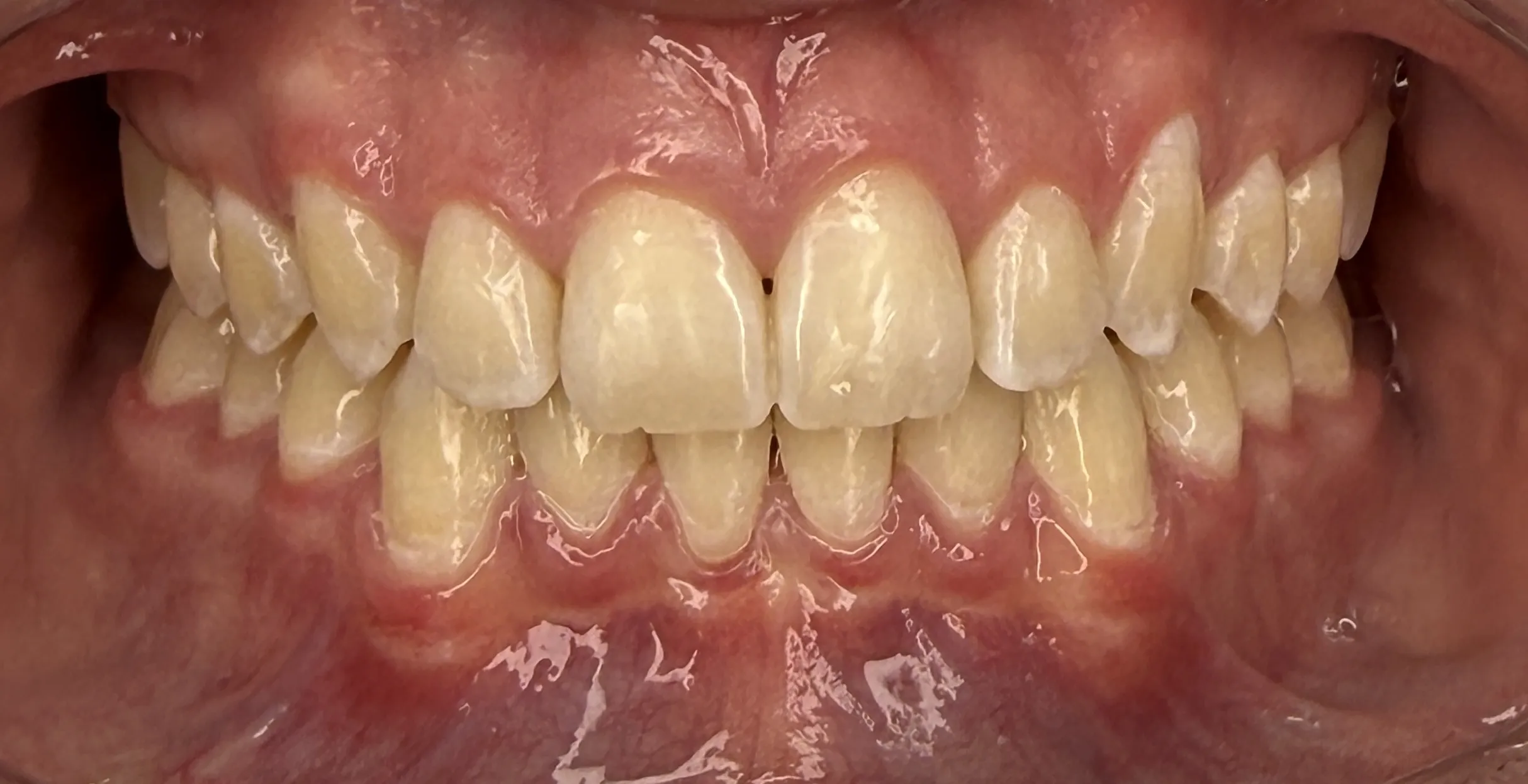 Depois - Invisalign