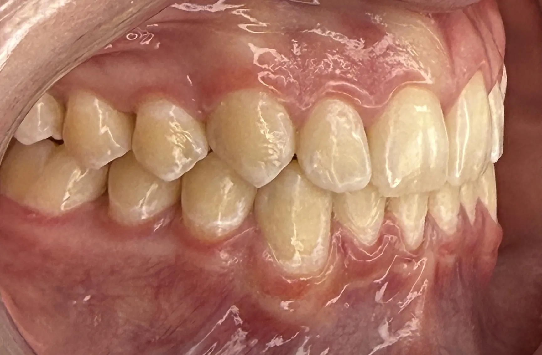 Depois - Invisalign