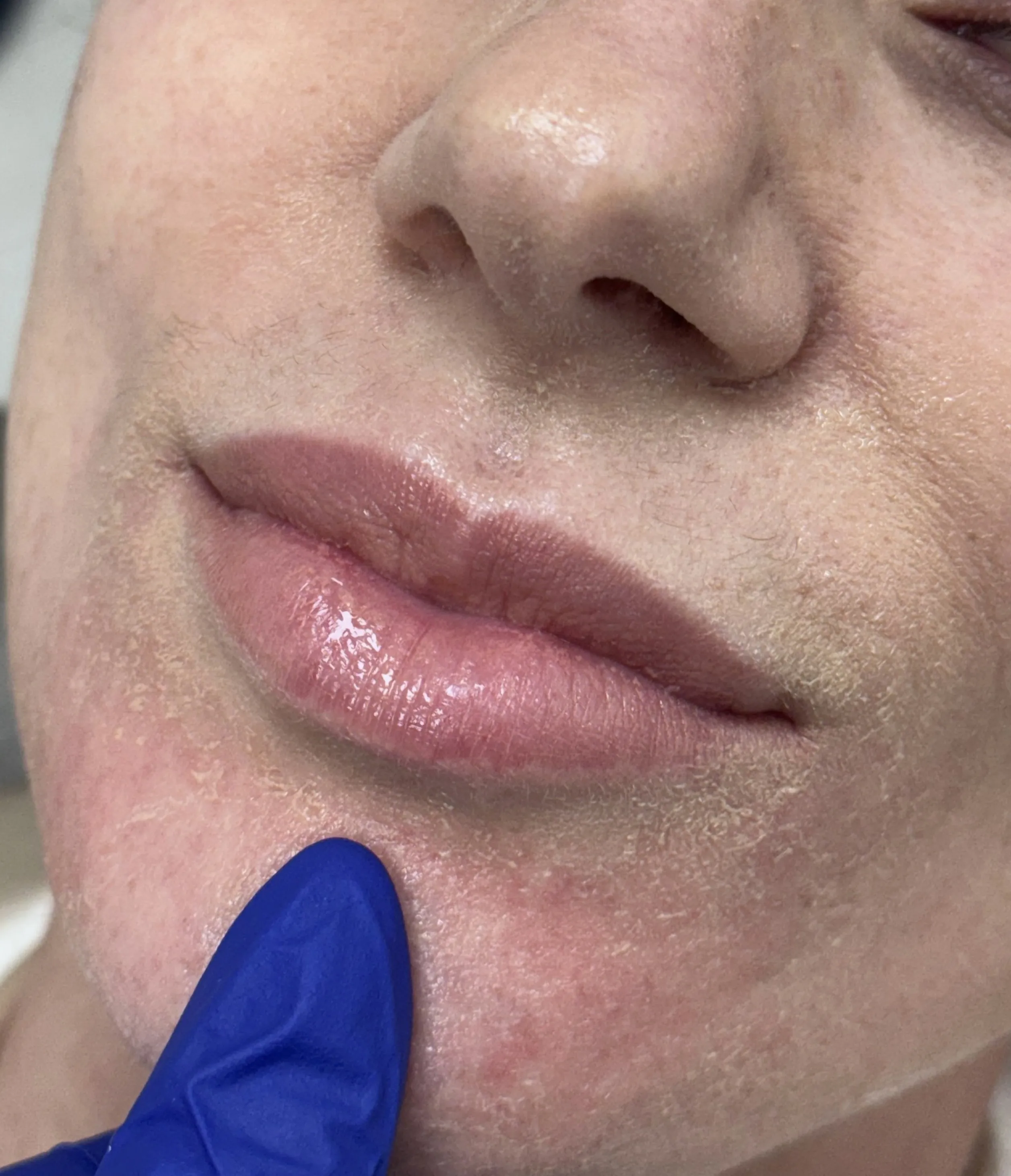 Antes - Preenchimento Labial