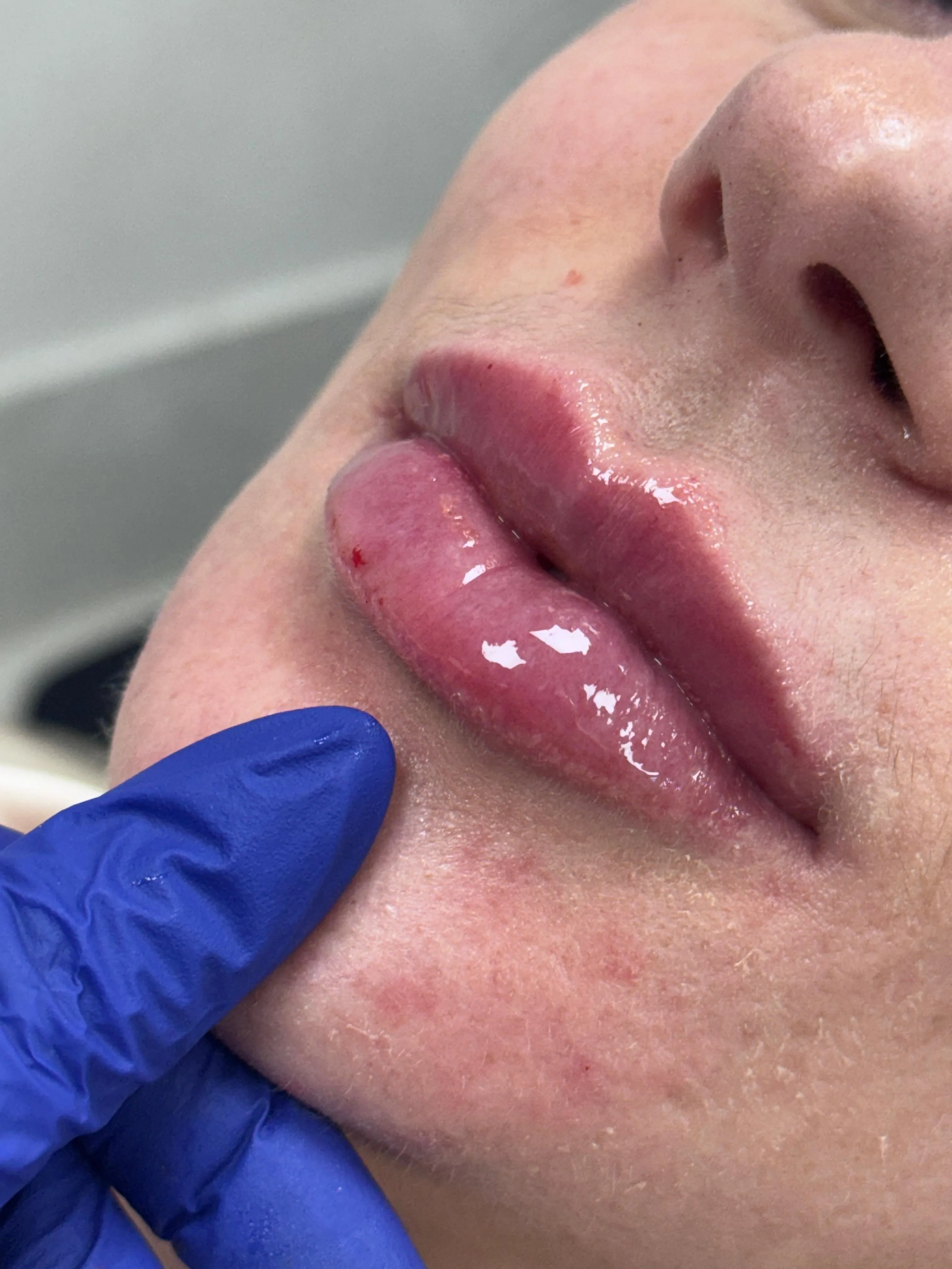 Depois - Preenchimento Labial