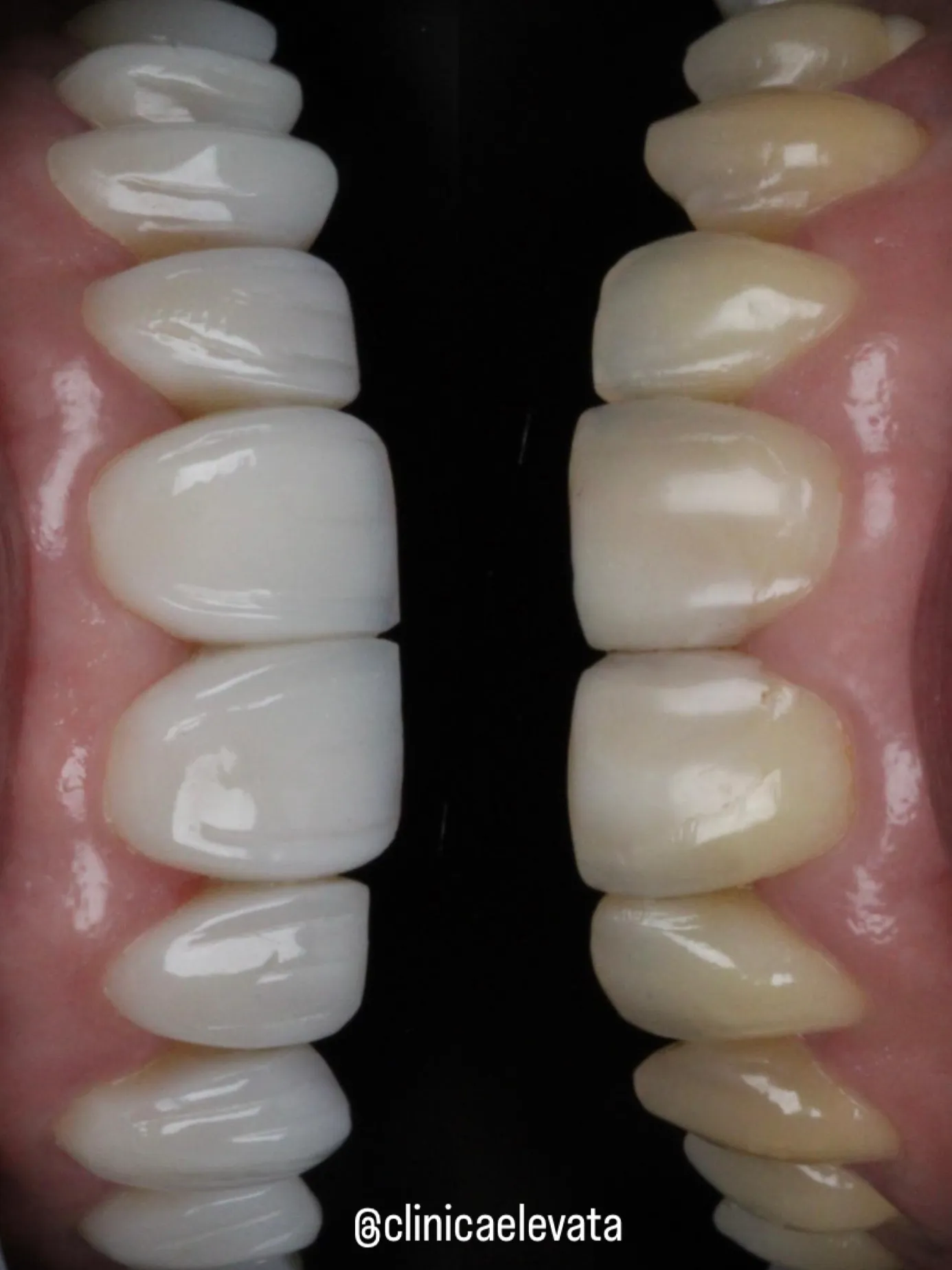 Antes e Depois - Lentes em Resina