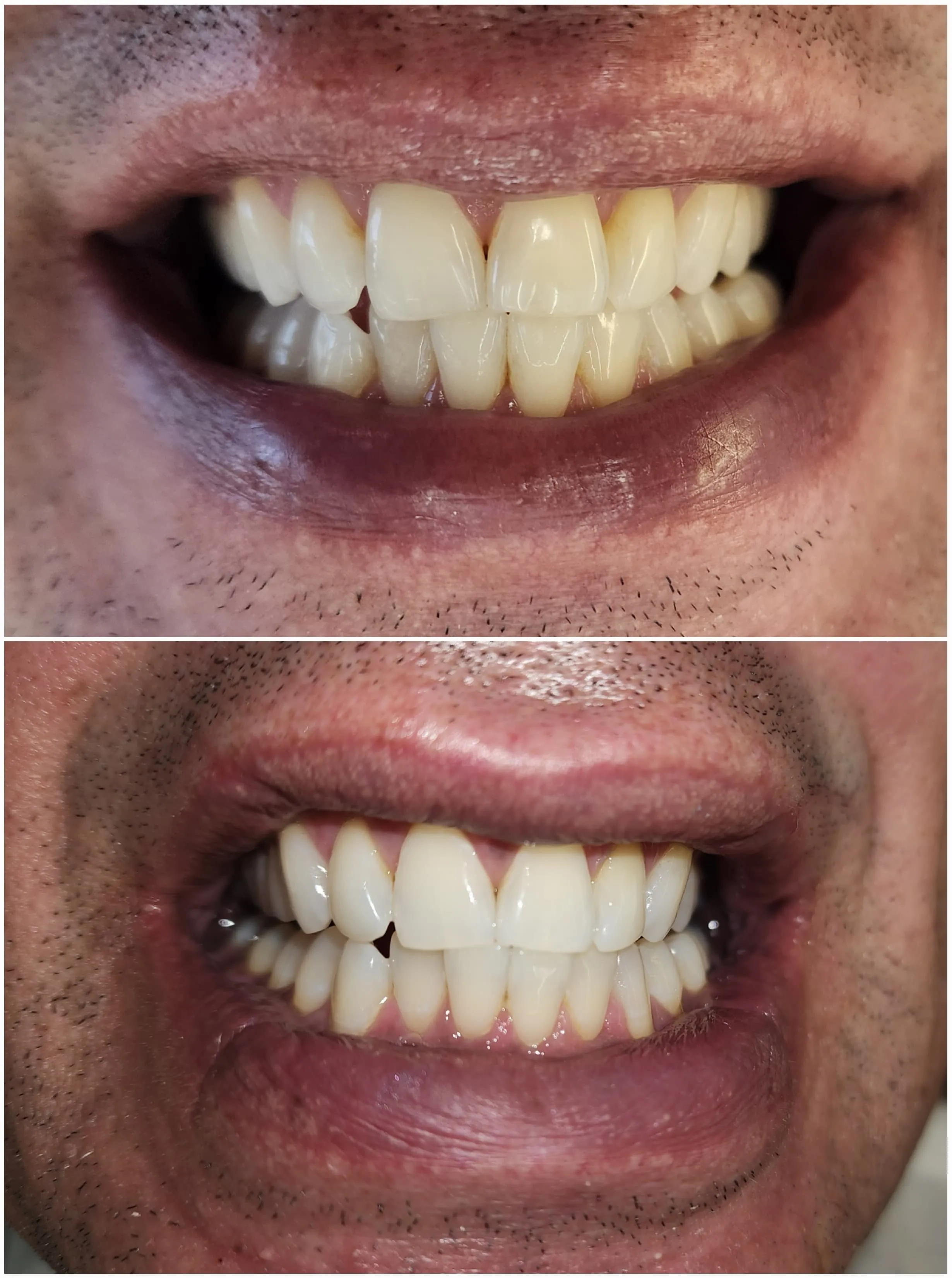 Clareamento - Antes e Depois