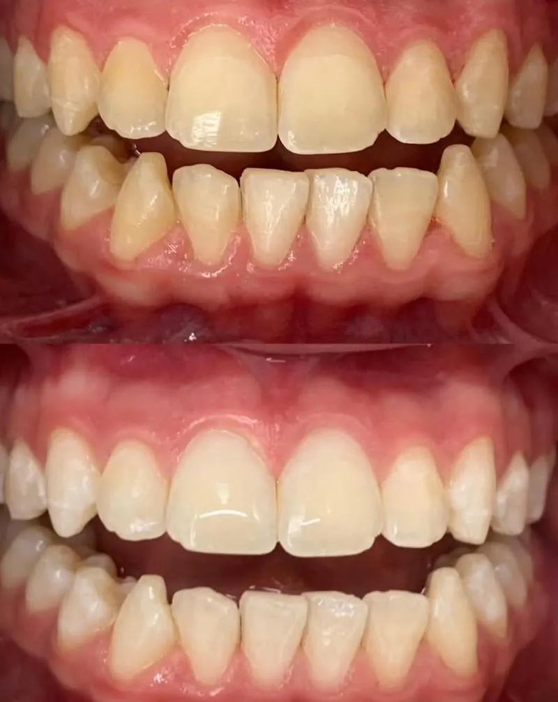 Clareamento - Antes e Depois