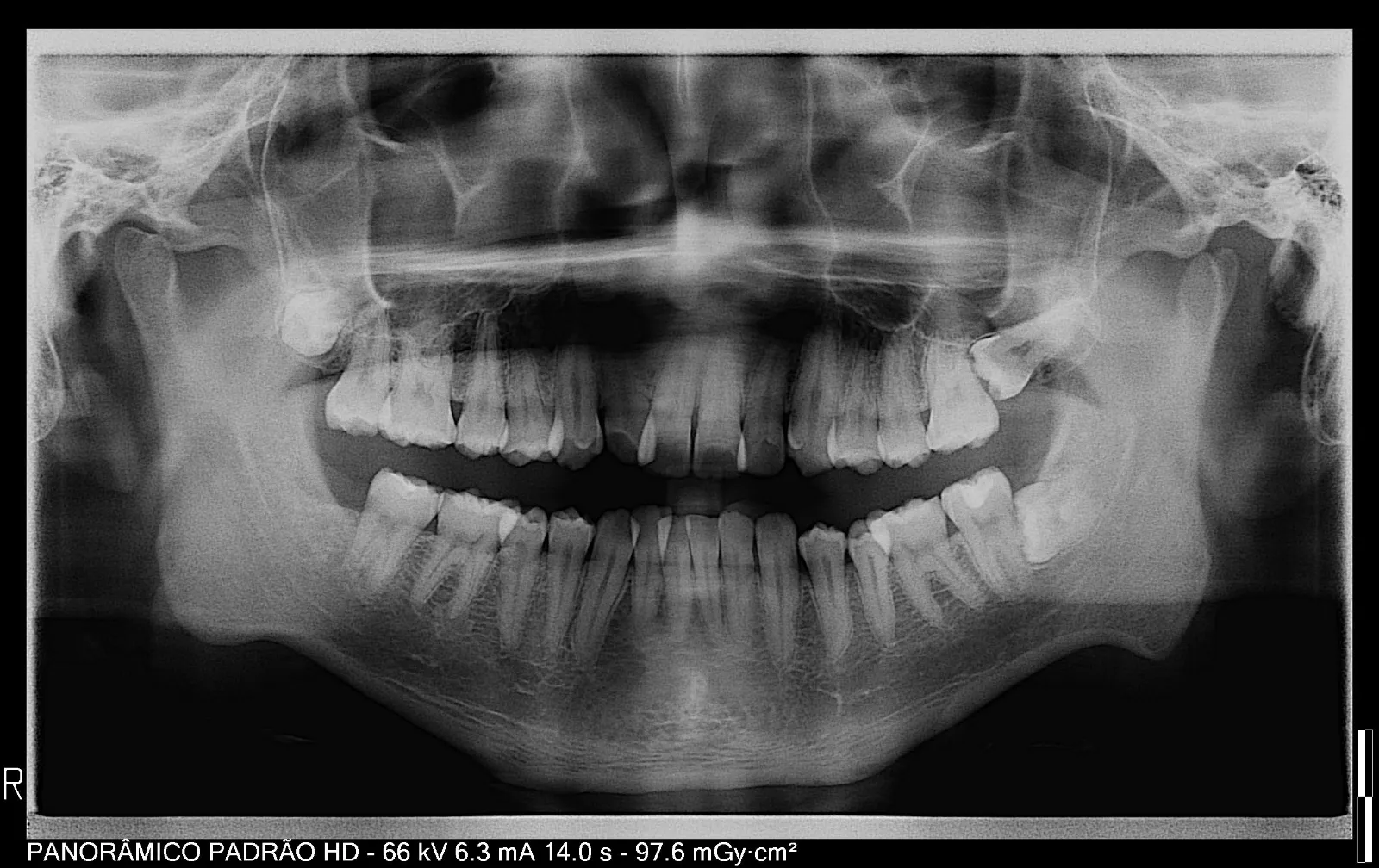 Radiografia Panorâmica