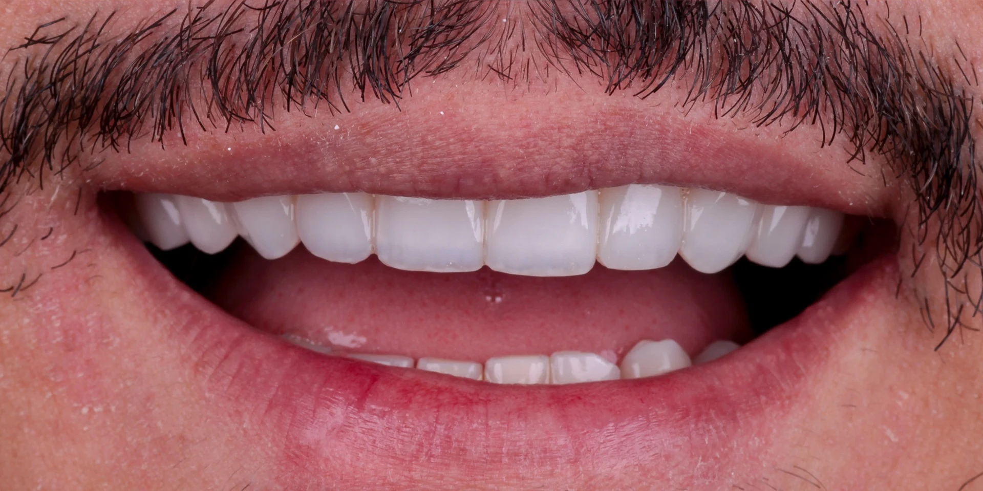Resultado de lentes resina, depois do tratamento