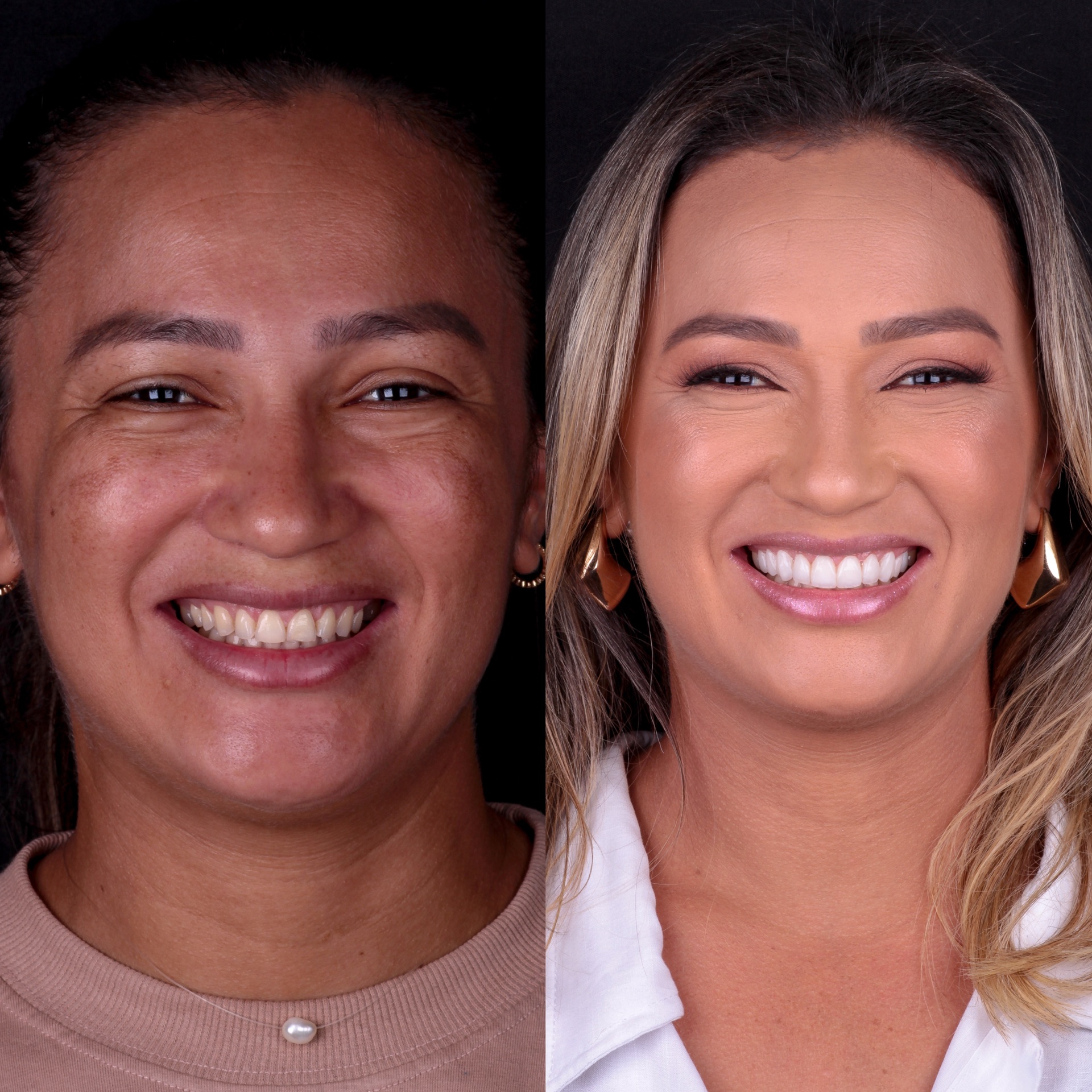 Antes e depois lentes em resina 1