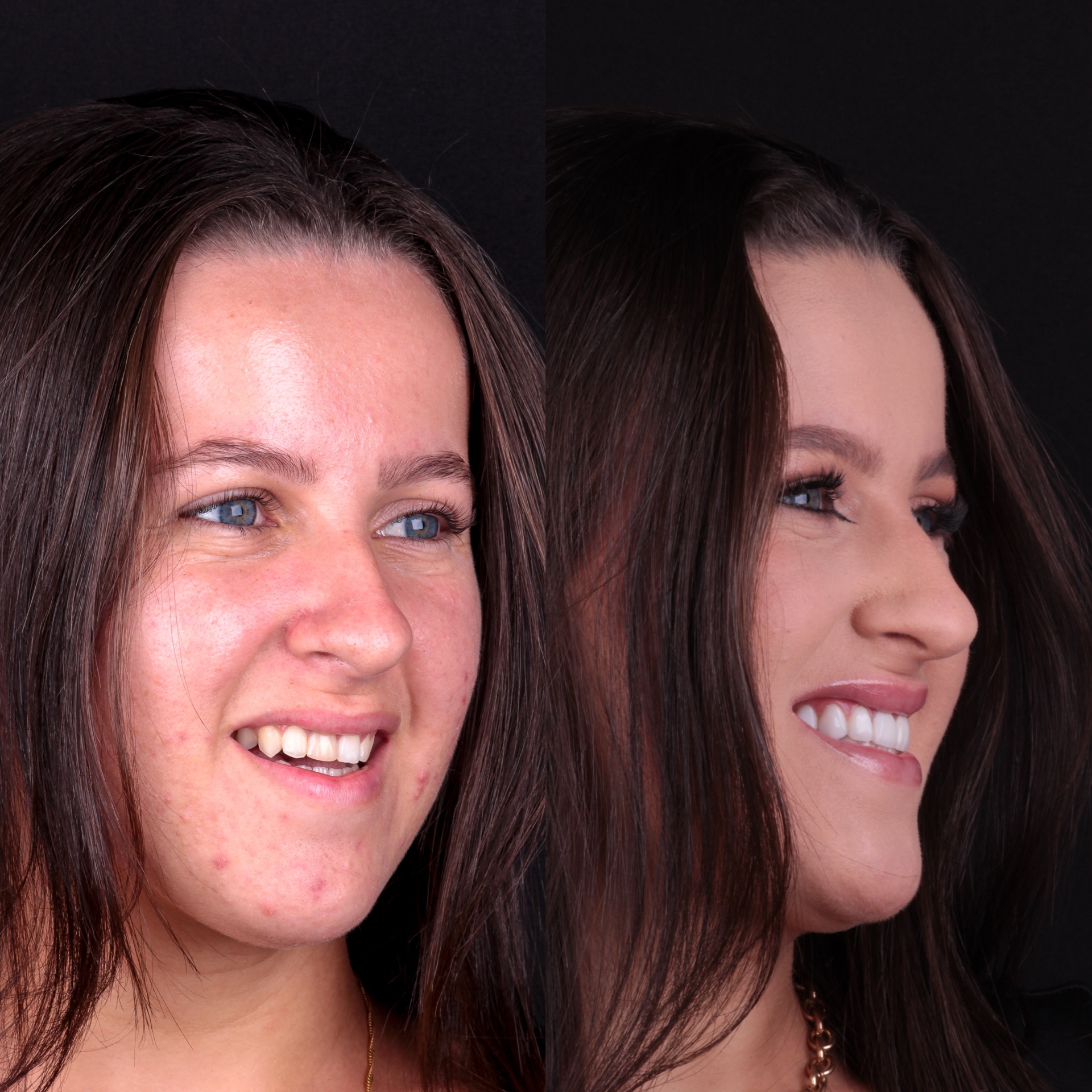 Antes e depois lentes em resina 2