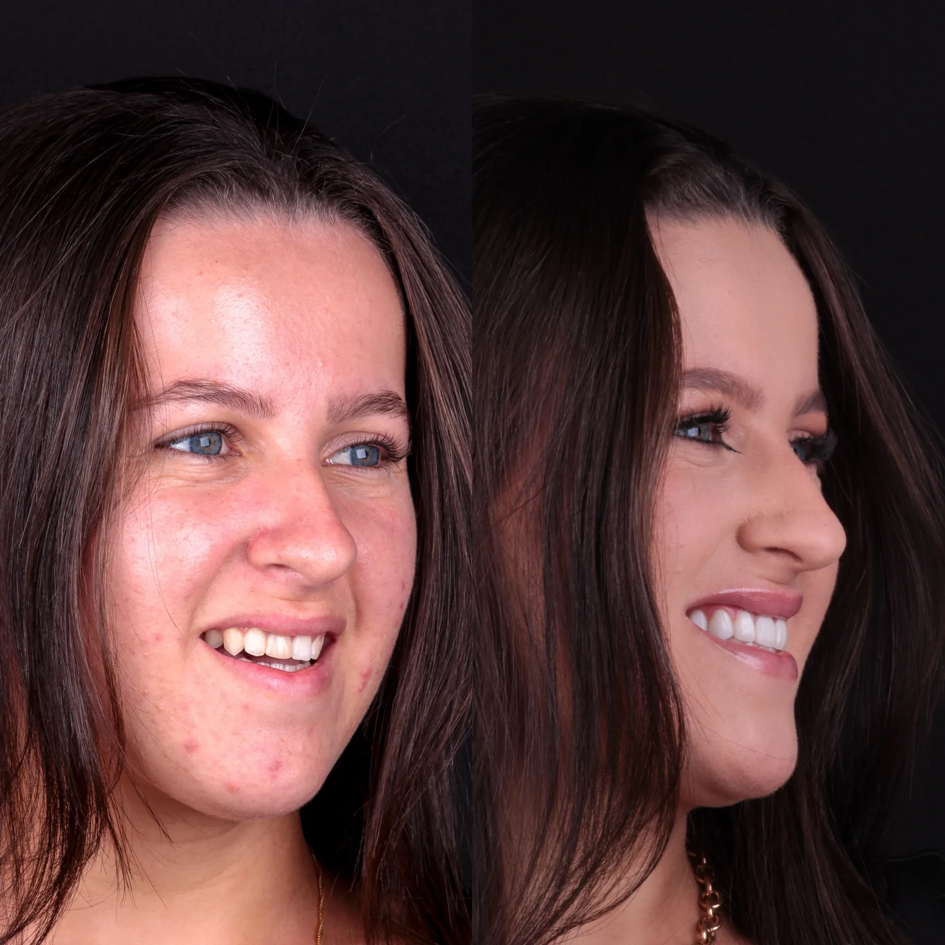 Antes e depois lentes em resina 2