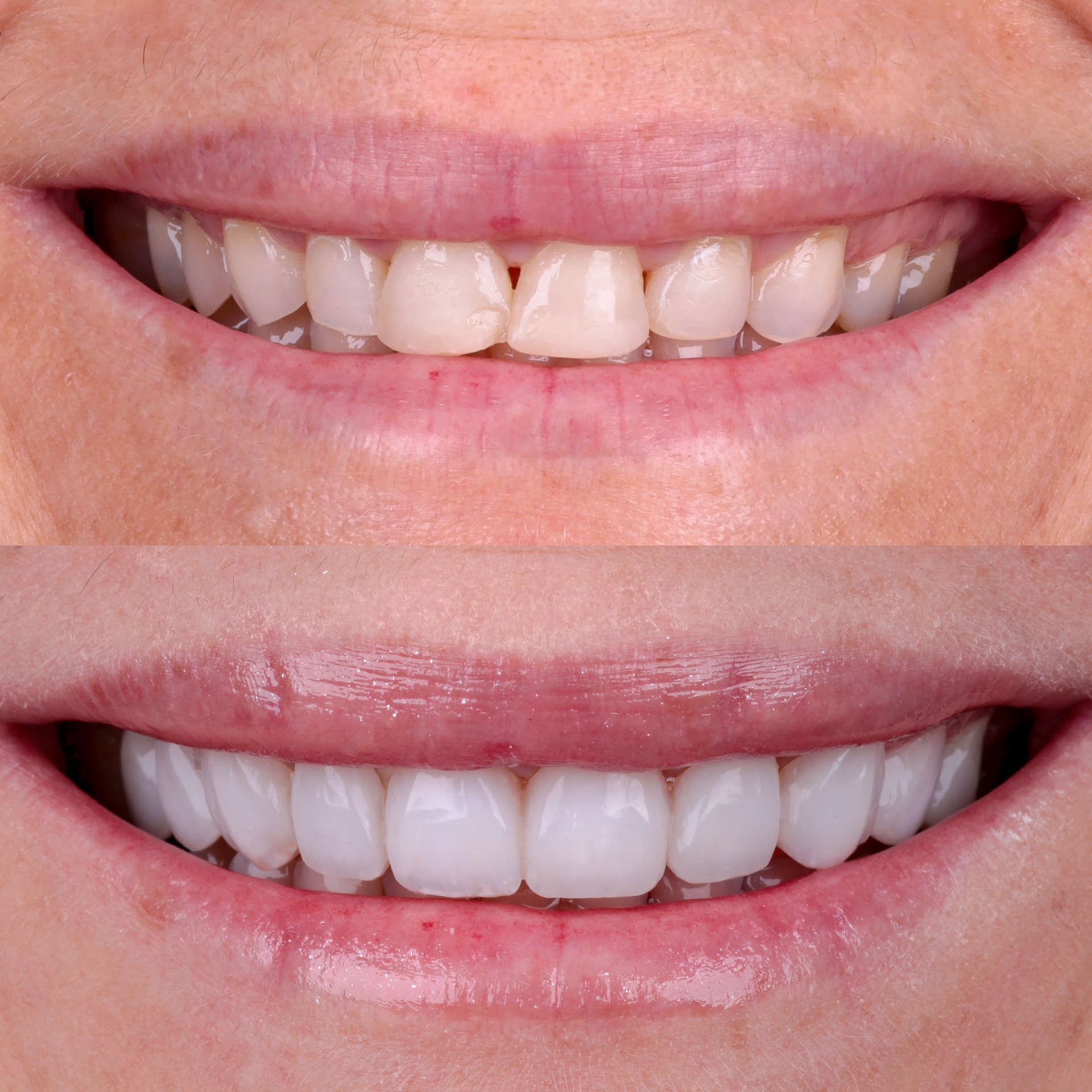 Antes e depois lentes em resina 3