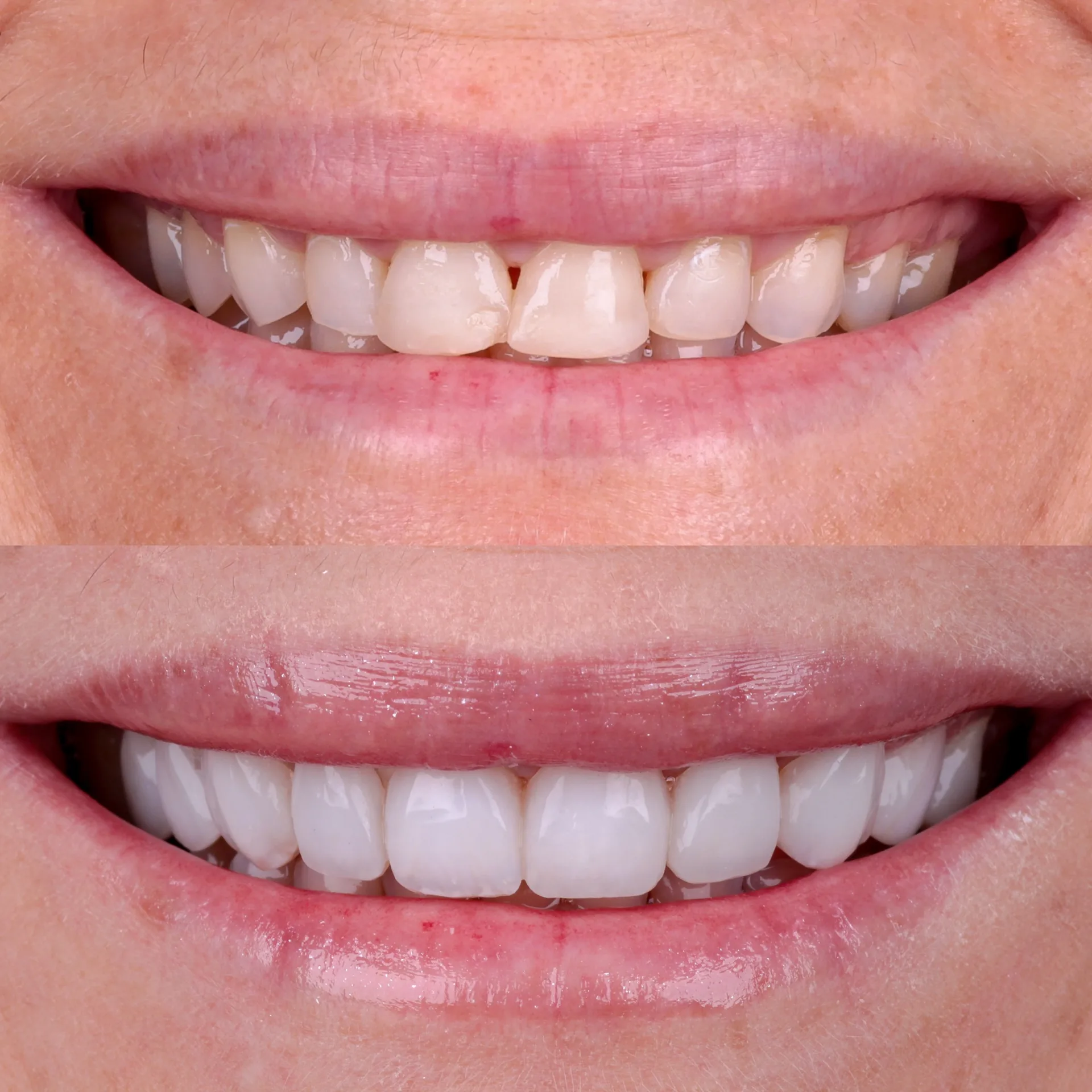 Antes e depois lentes em resina 3