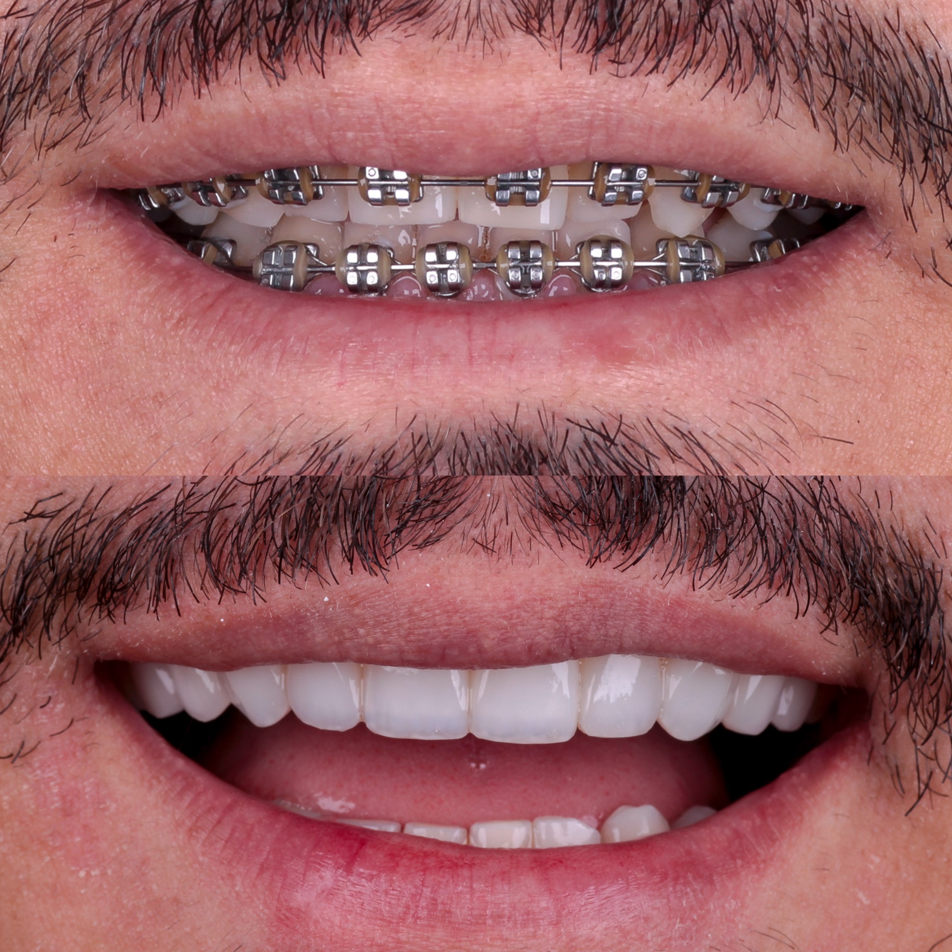 Antes e depois lentes em resina 4