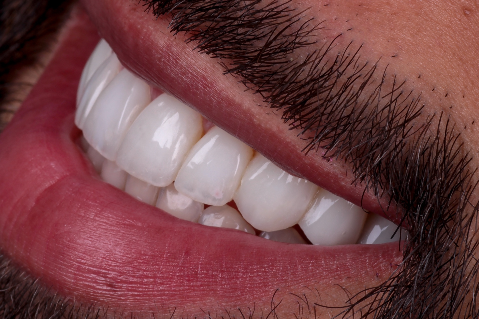 Lentes de Contato Dental