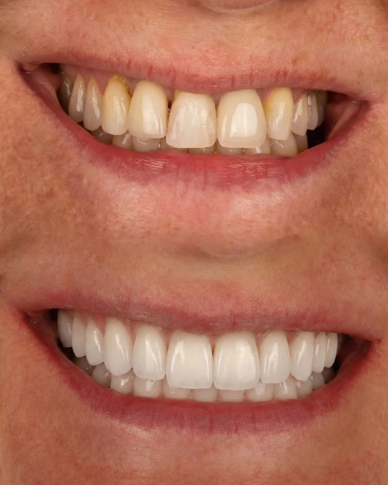 Facetas de Porcelana