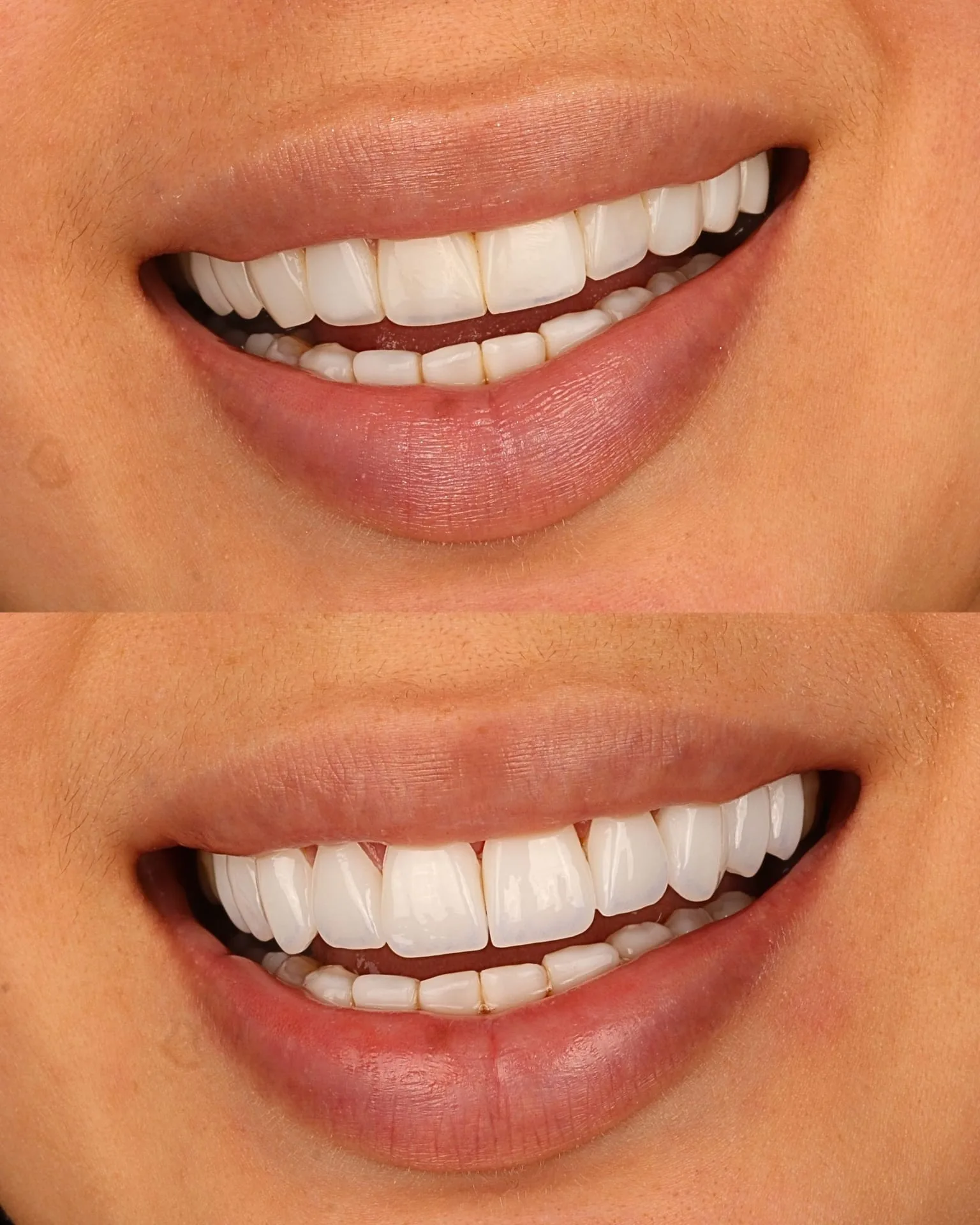 Resultado transformacao sorriso