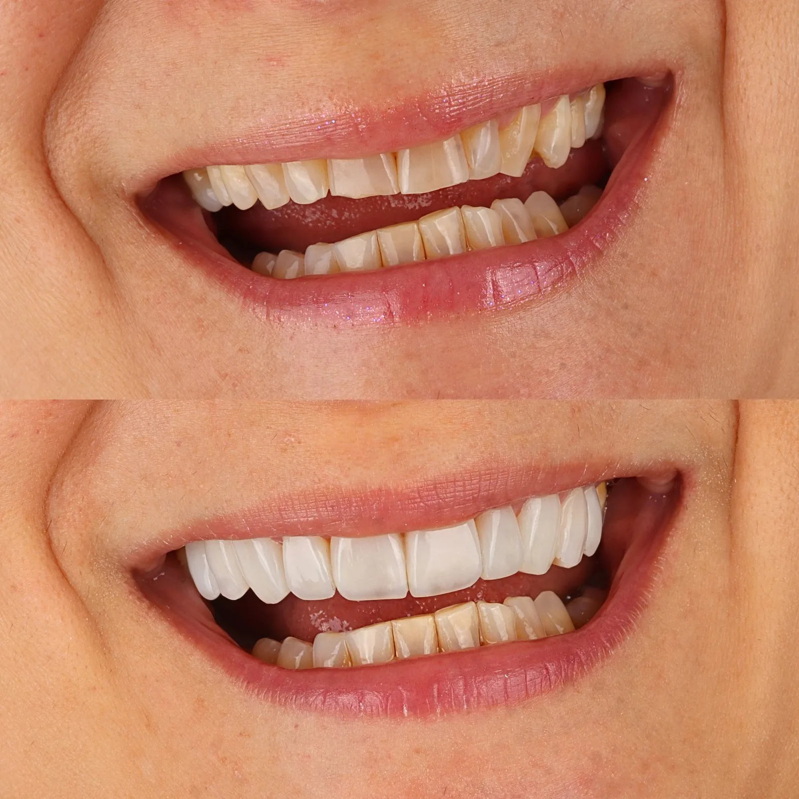 Resultado transformacao sorriso