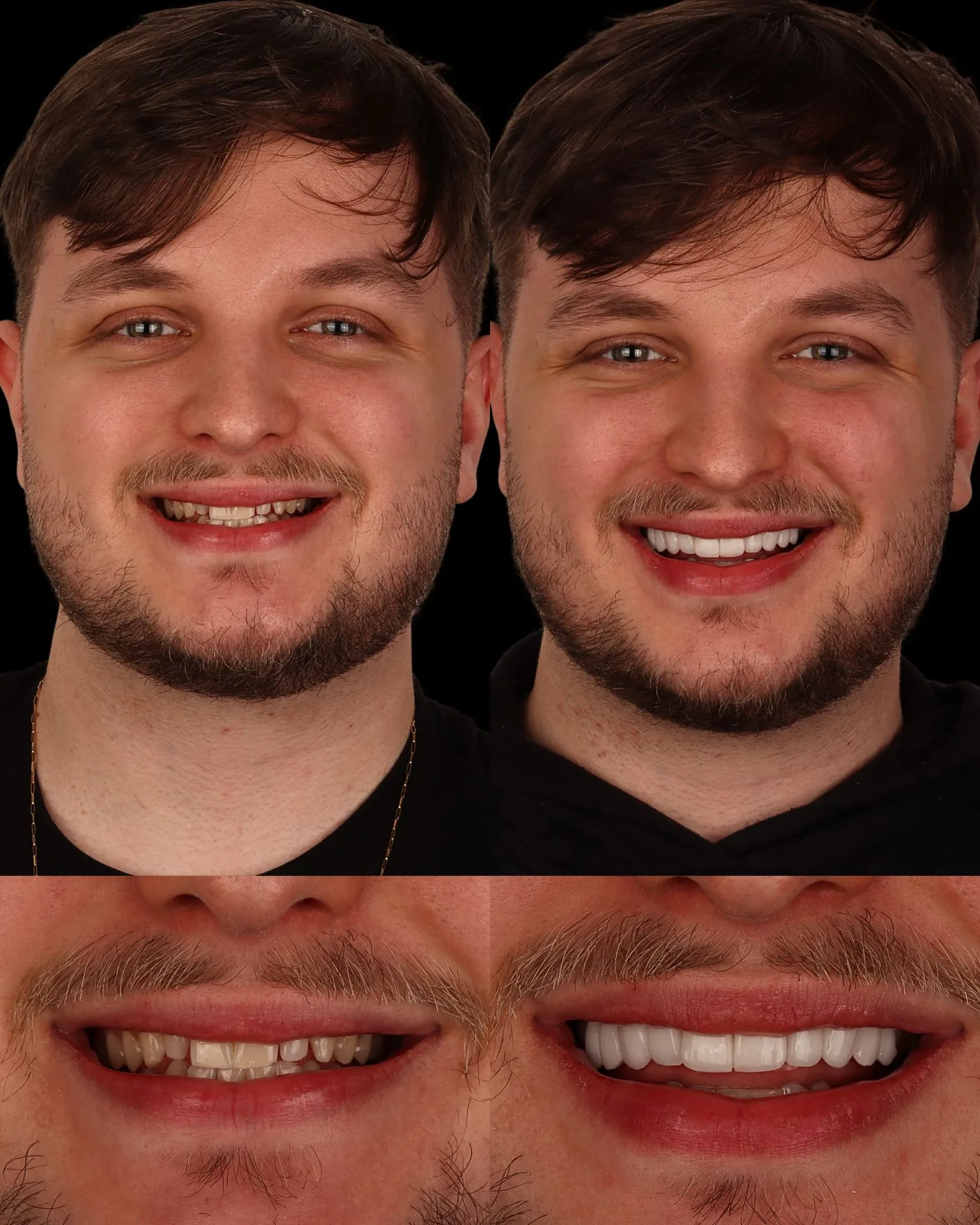 Resultado transformacao sorriso