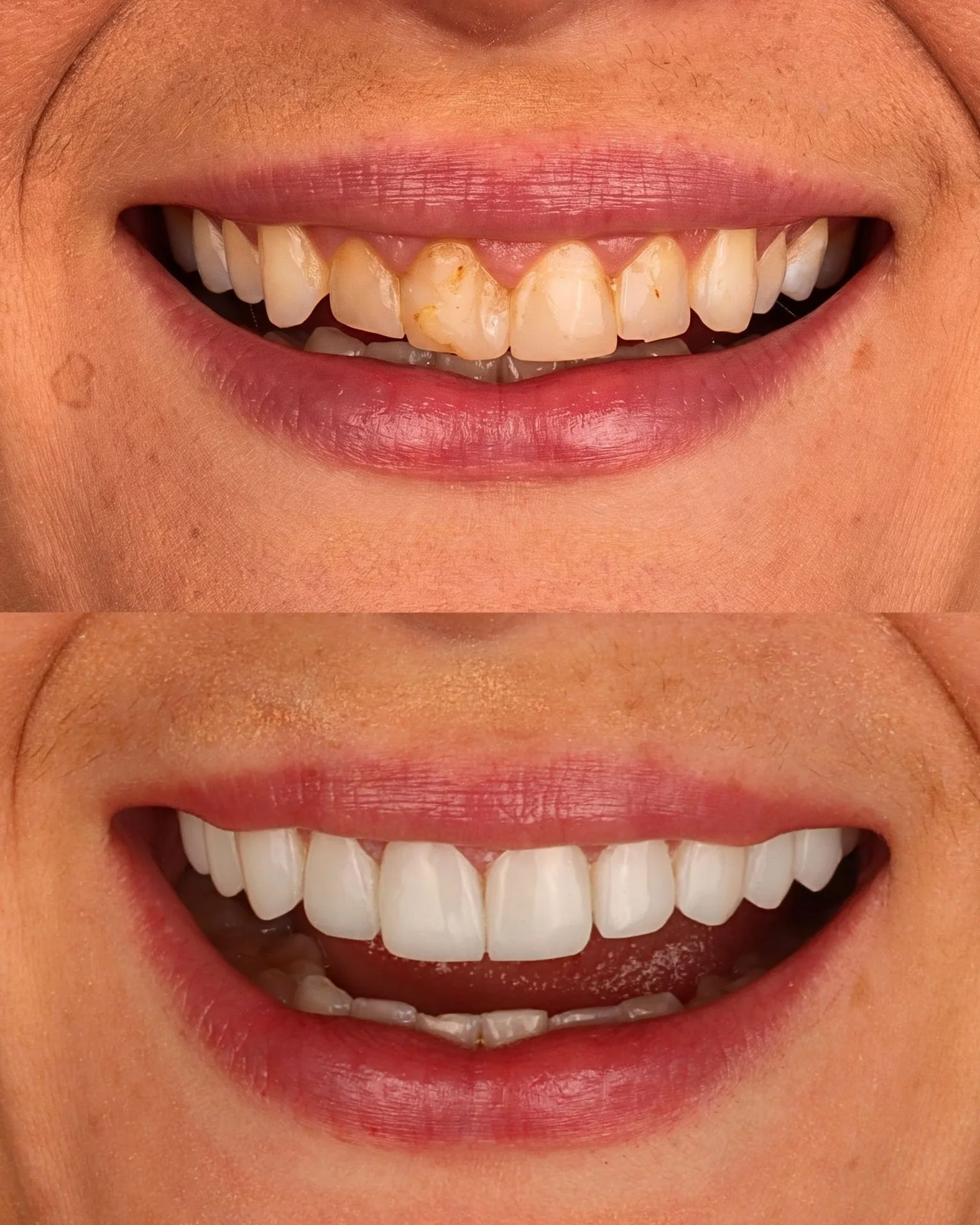 Resultado transformacao sorriso
