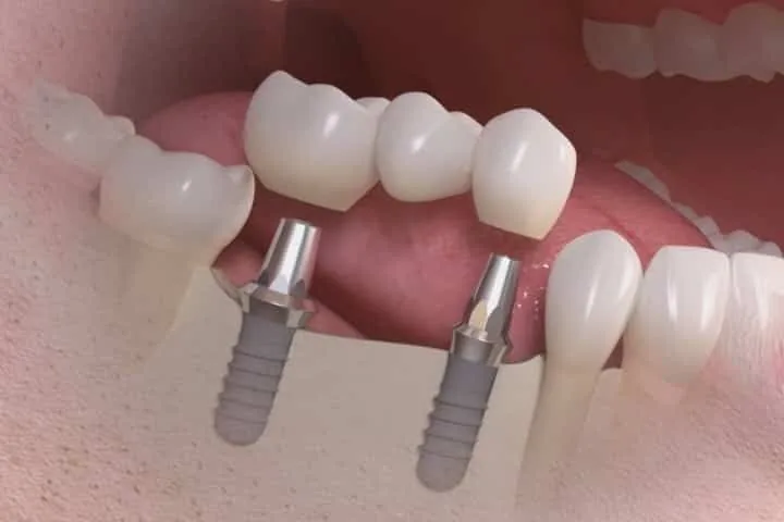 Implantes Dentários