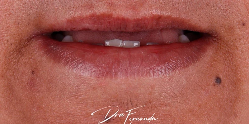 Resultado de implantes, antes do tratamento