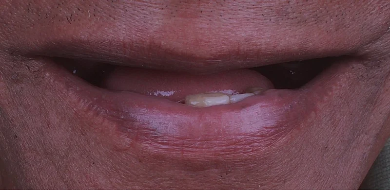 Resultado de implantes, antes do tratamento
