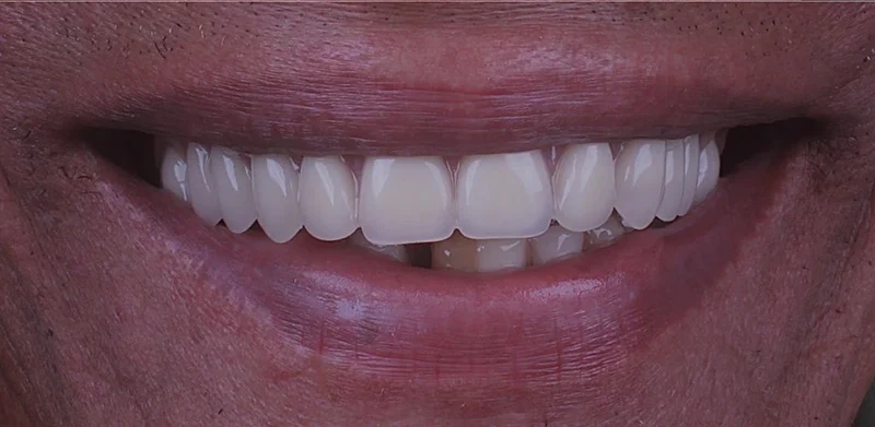 Resultado de implantes, depois do tratamento