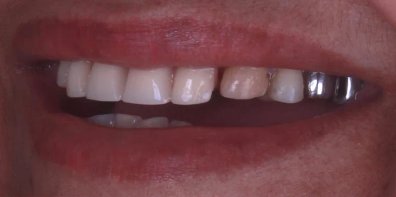 Resultado de implantes, antes do tratamento