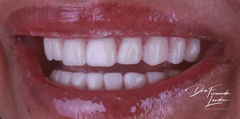 Resultado de implantes, depois do tratamento