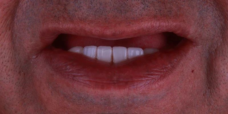 Resultado de implantes, antes do tratamento