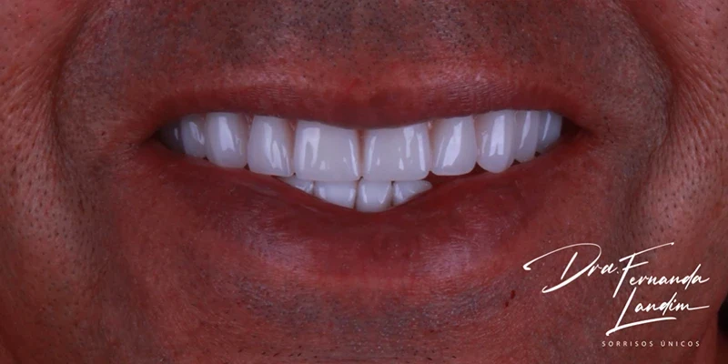 Resultado de implantes, depois do tratamento