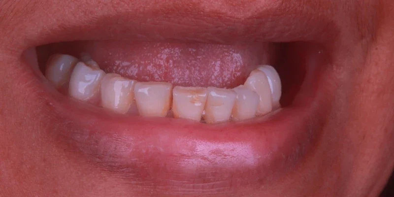 Resultado de implantes, antes do tratamento
