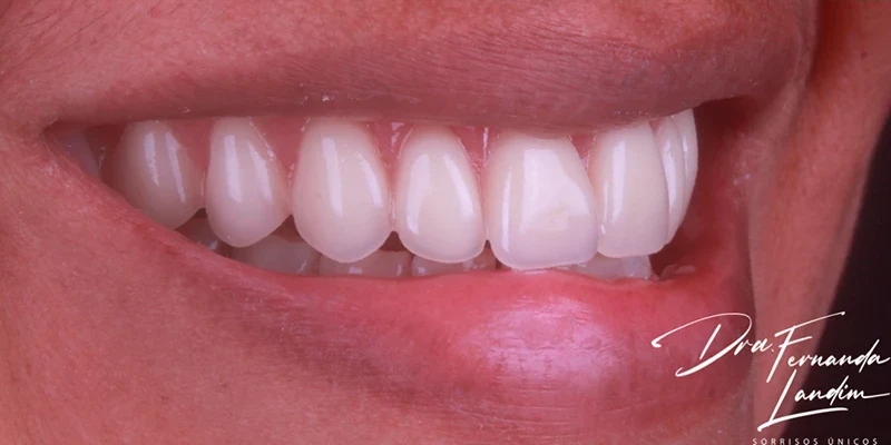 Resultado de implantes, depois do tratamento