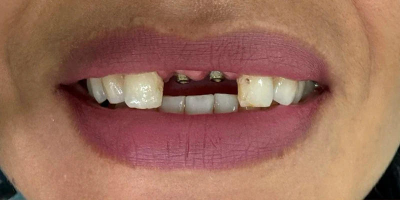 Resultado de implantes, antes do tratamento