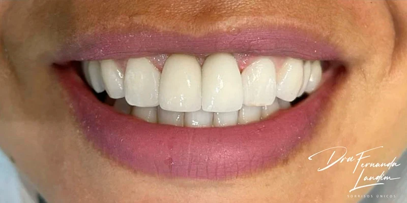 Resultado de implantes, depois do tratamento