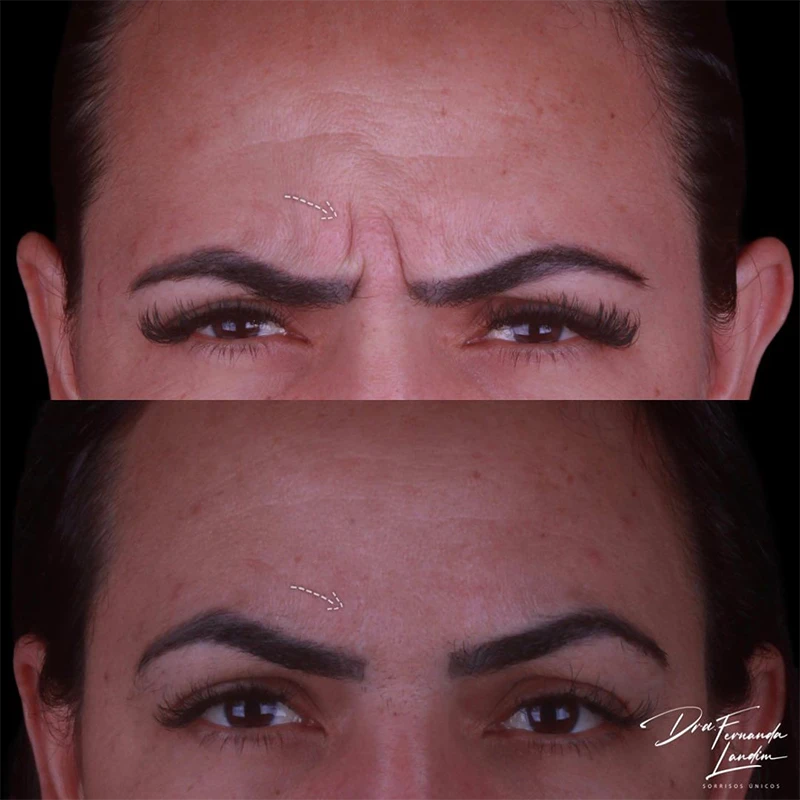 Resultado Botox Estético