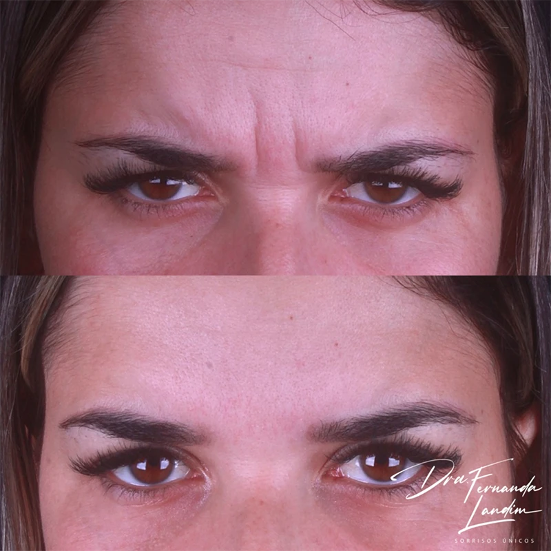 Resultado Botox Estético