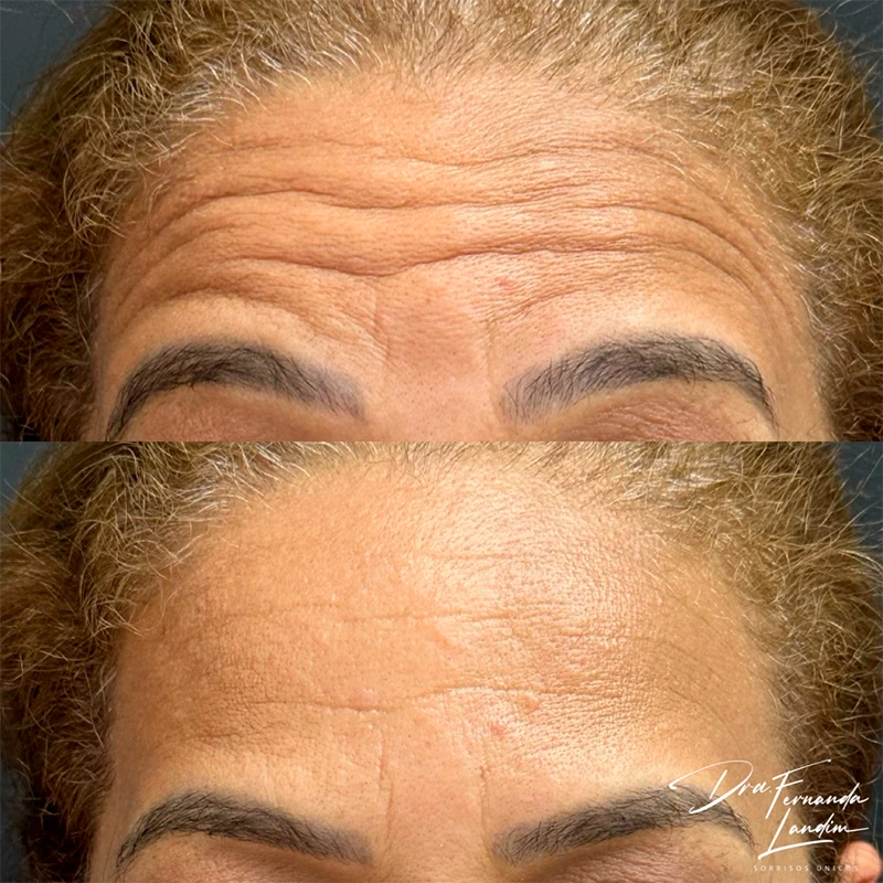 Resultado Botox Estético