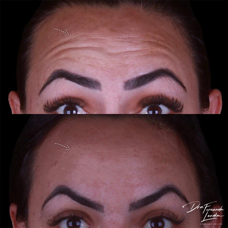 Resultado Botox Estético