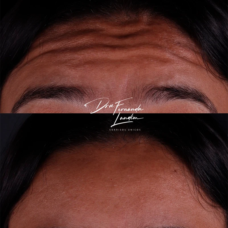 Resultado Botox Estético