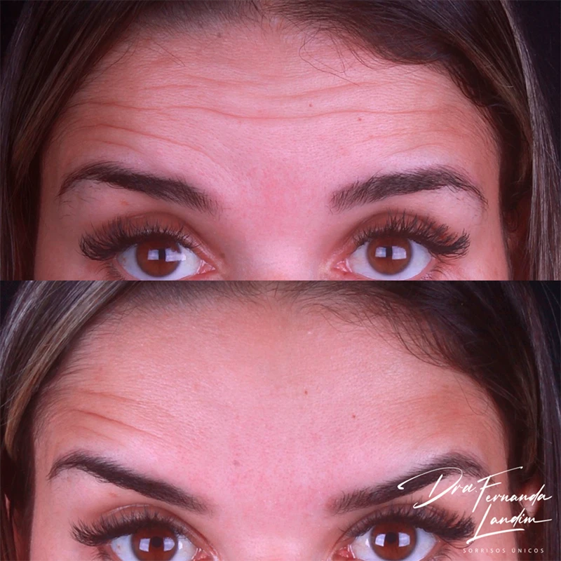 Resultado Botox Estético