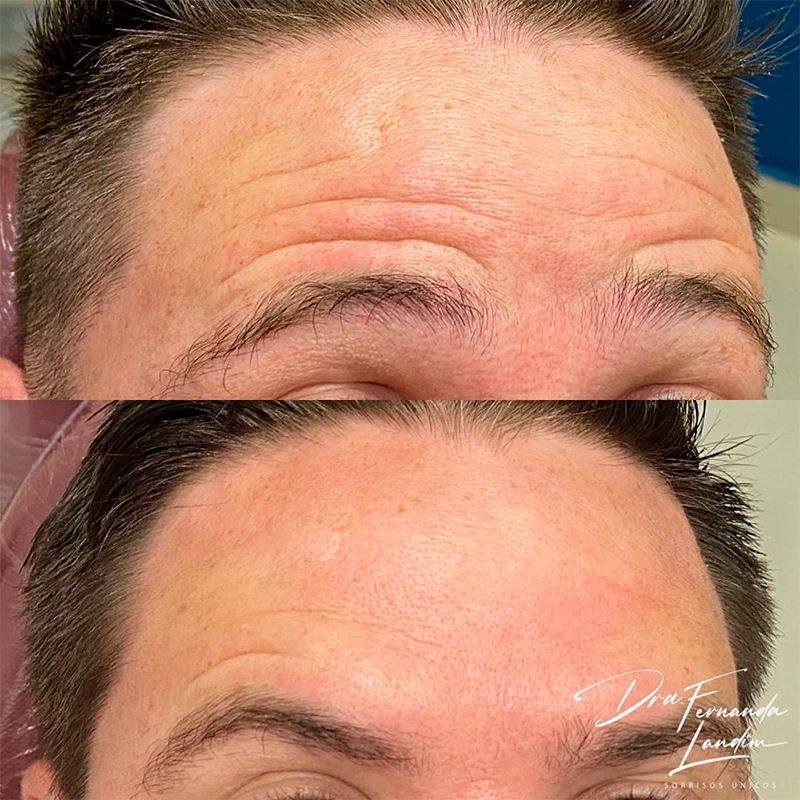 Resultado Botox Estético