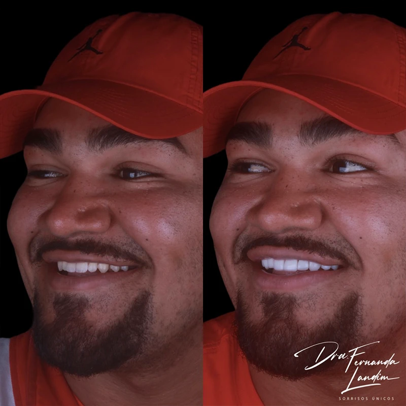Resultado Facetas em Resina