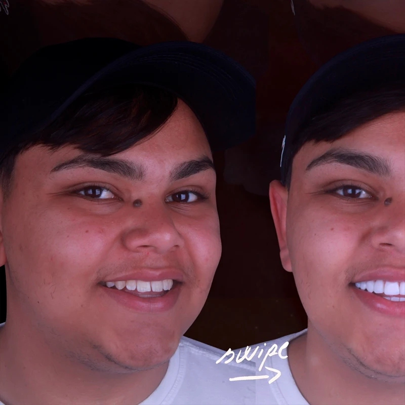 Resultado Facetas em Resina