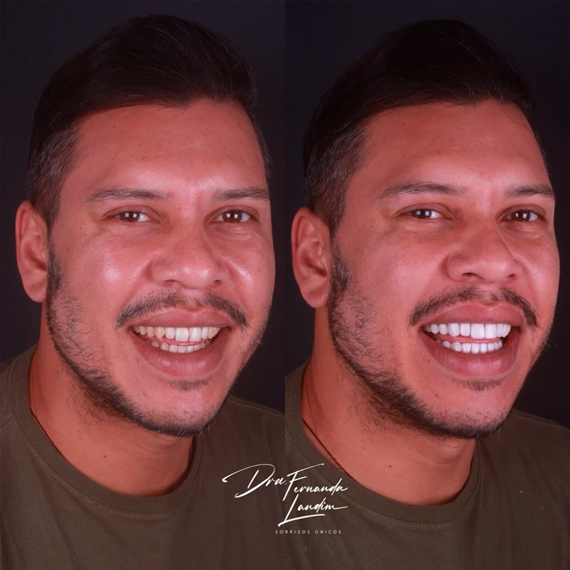 Resultado Facetas em Resina