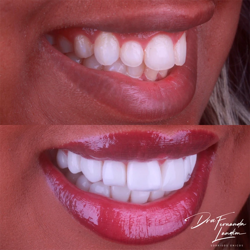 Resultado Facetas em Resina
