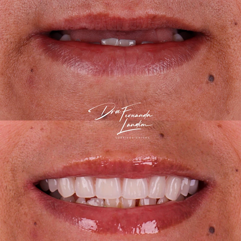 Resultado Implantes Dentários