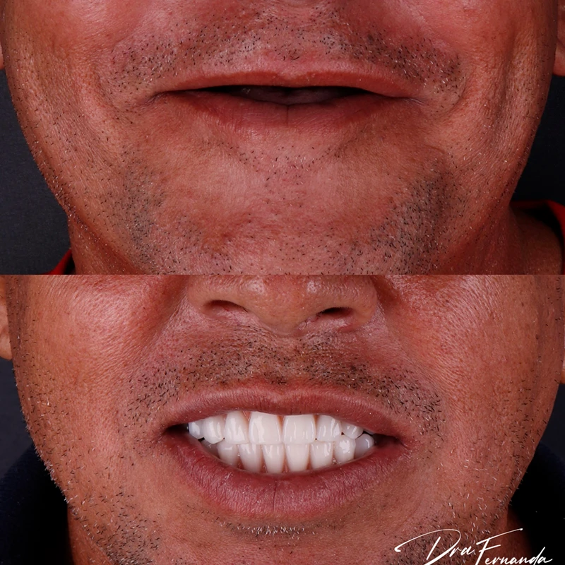 Resultado Implantes Dentários