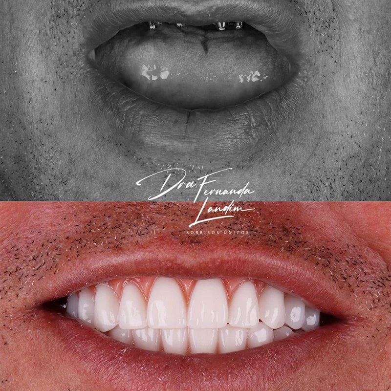 Resultado Implantes Dentários