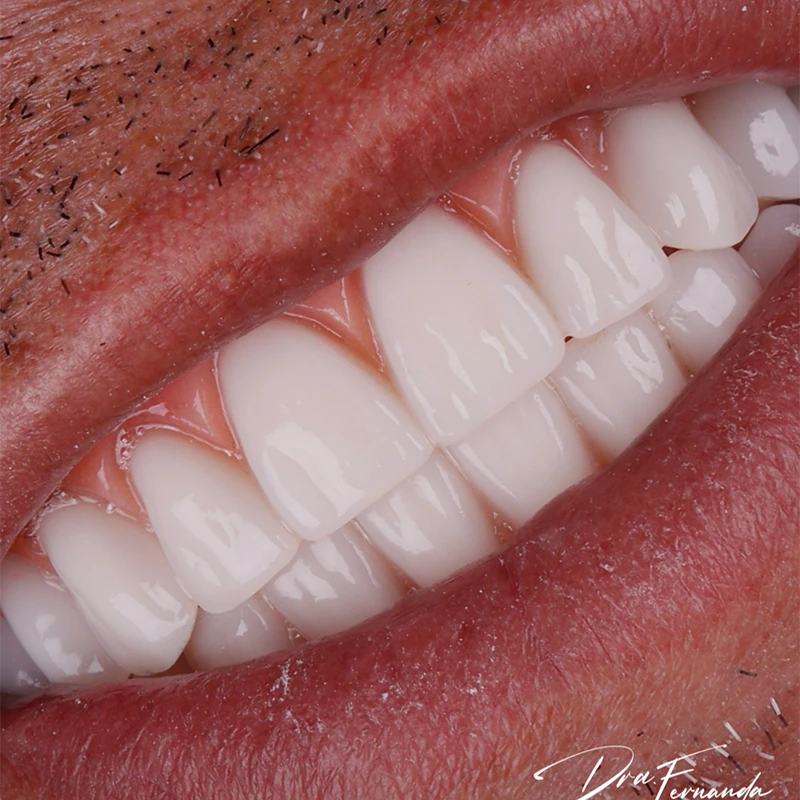 Resultado Implantes Dentários